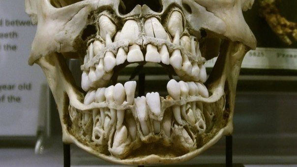 Все дети имеют второй ряд зубов, которые впоследствии начнут расти и заменят собой молочные зубы.