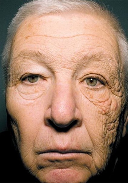 Этому человеку 69 лет, но половина его лица выглядит намного старше, благодаря солнечным лучам, которые годами светили на его левую сторону.  